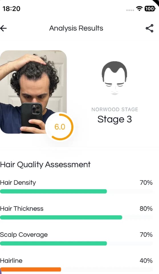 The Balding AI analysis screen showing an overall score of 6.0, a Norwood stage, and percentage bars for hair density, thickness, scalp coverage, and hairline